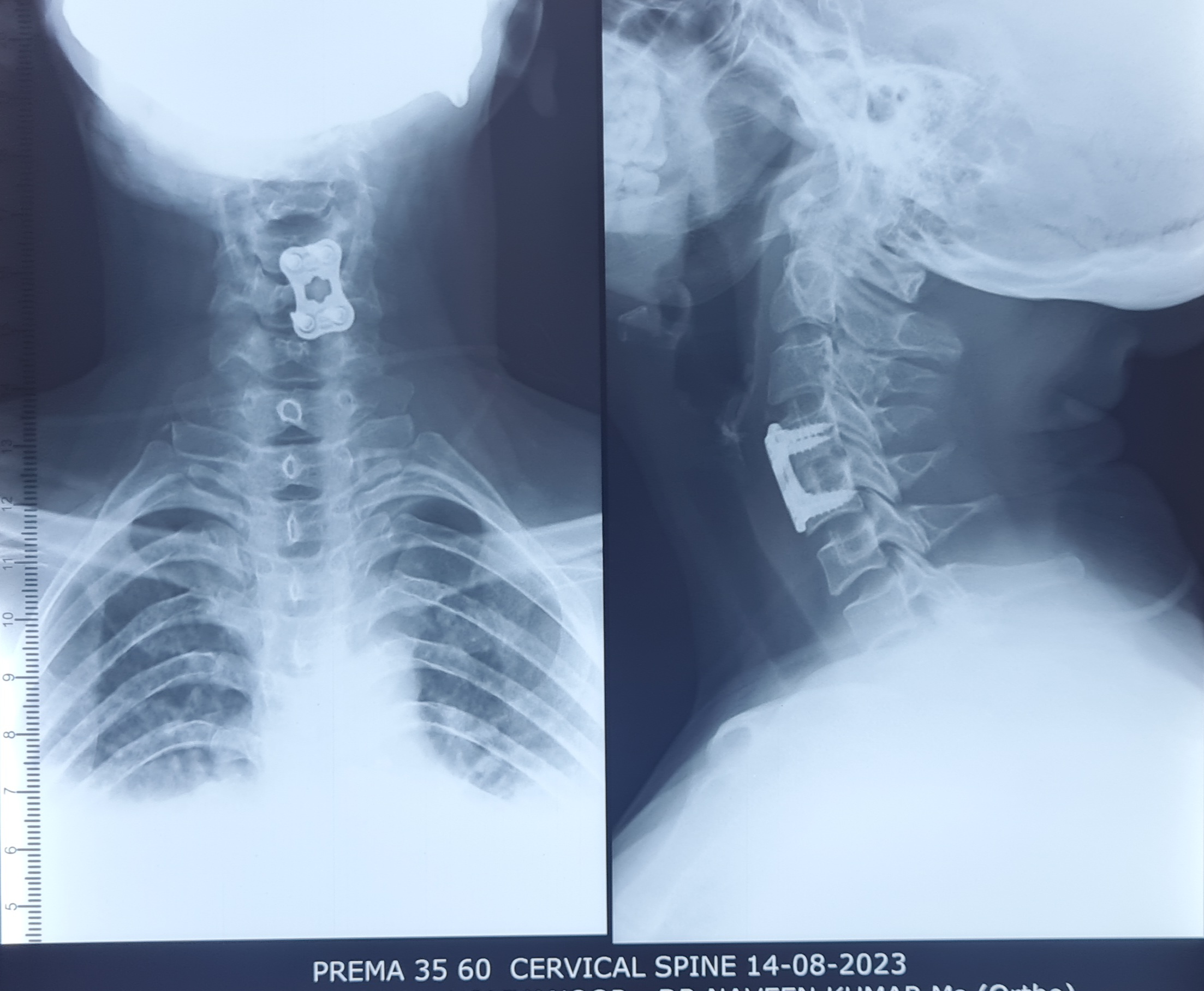 Post-operative X-ray of cervical spine surgery