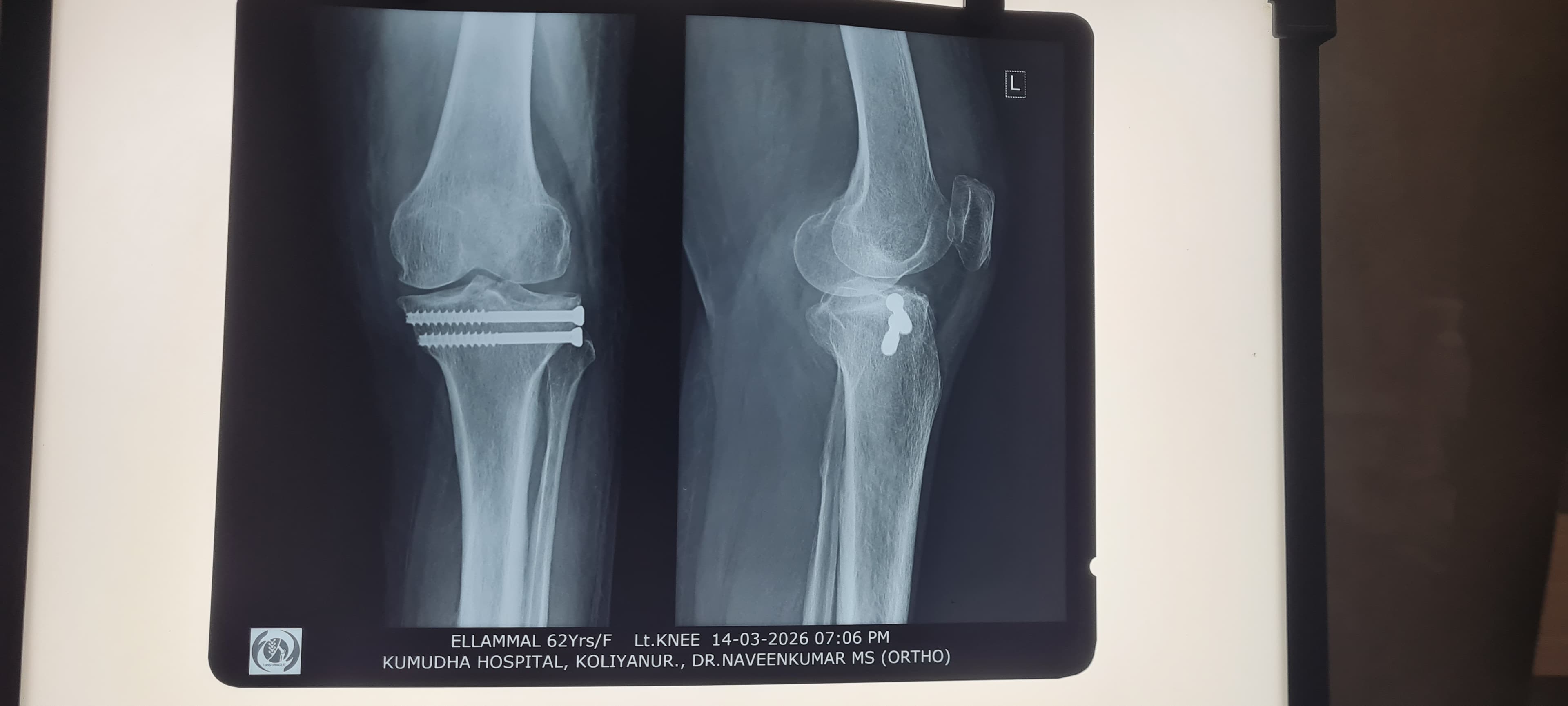 Post-operative X-ray of a fixed knee fracture