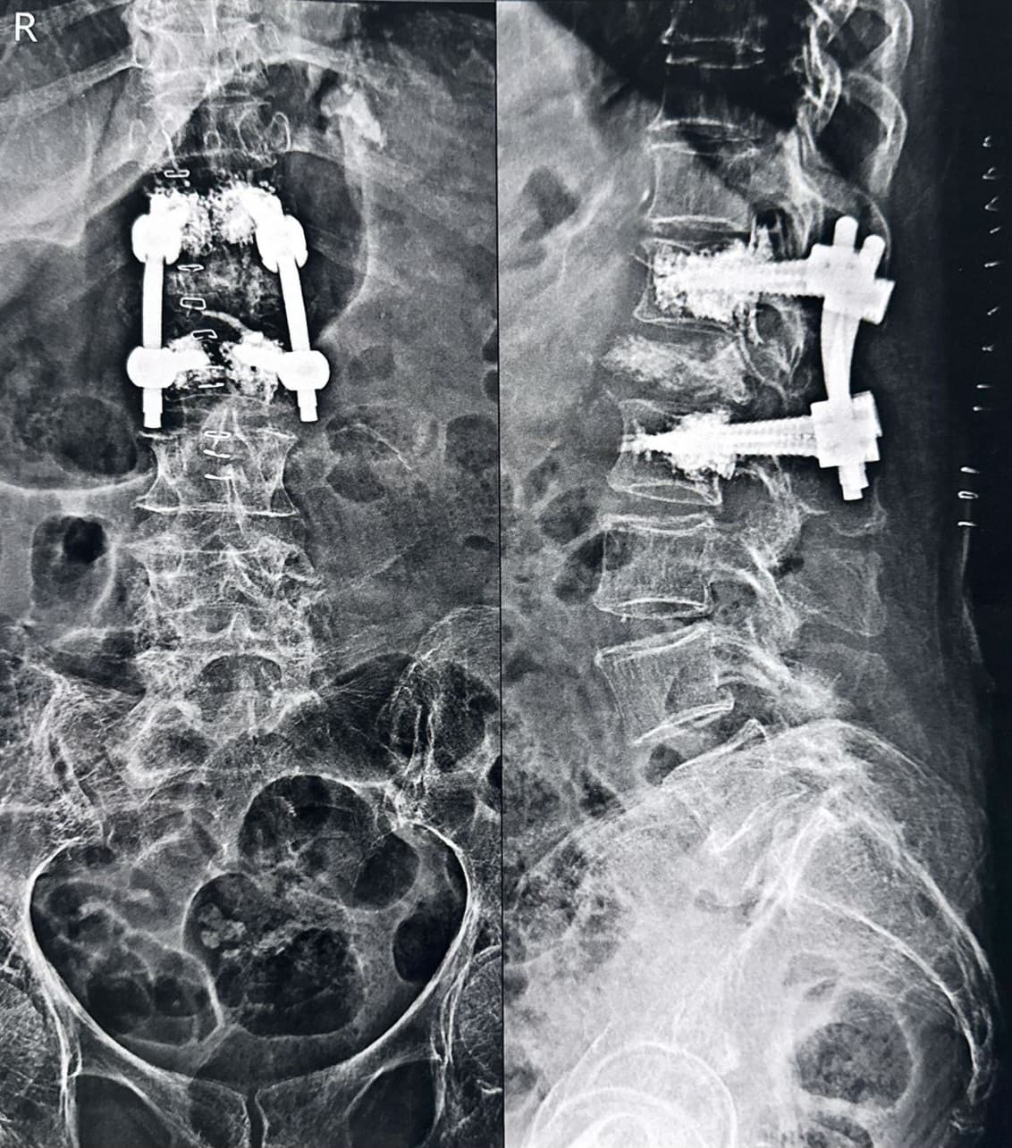 Post-operative X-ray of lumbar spine fixation