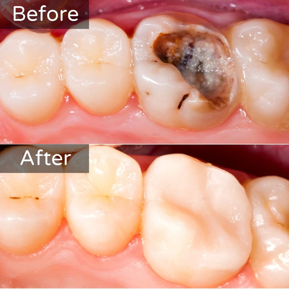 Tooth-coloured filling — before and after