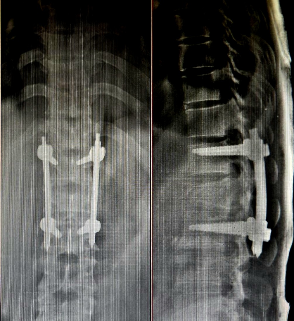 Post-operative X-ray of spinal fixation surgery