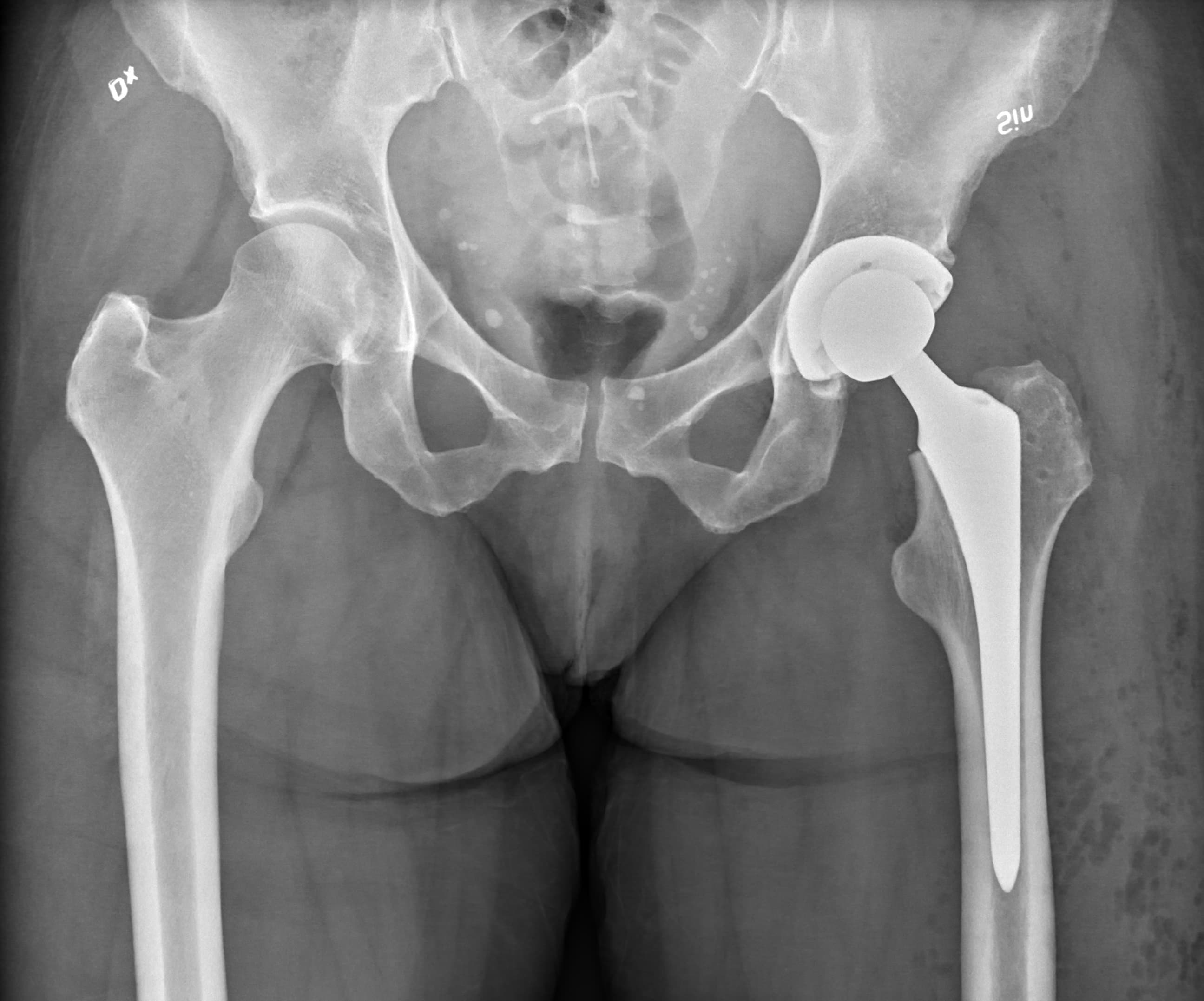 Post-operative X-ray of a total hip replacement